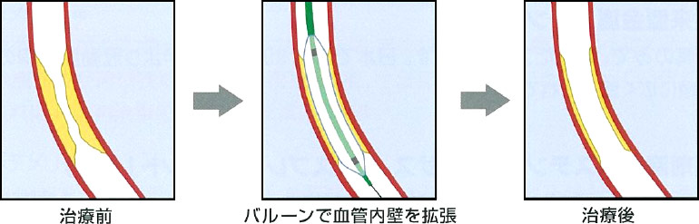 治療イメージ
